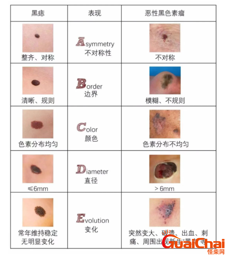 痣与黑色素瘤怎么区分？身上有痣需不需要点掉？