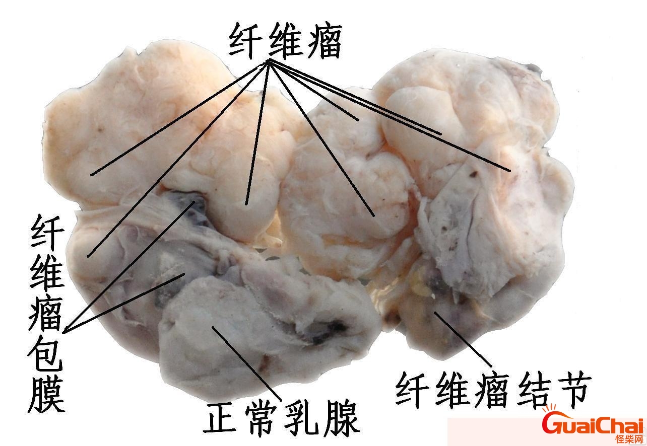 乳腺纤维瘤是什么东西严重吗？乳腺纤维瘤是怎么导致的