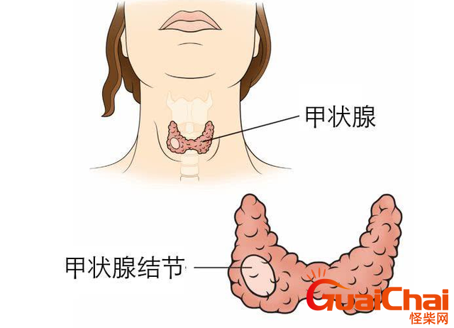 甲状腺结节吃什么药效果快？甲状腺结节吃什么药能根治