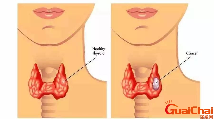 甲状腺结节是什么原因造成的怎么治疗？甲状腺结节是什么原因造成的中医解释