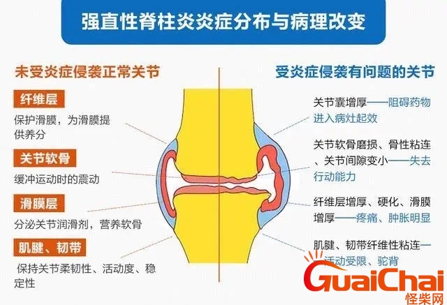 强直性脊柱炎6个地方疼用什么药？强直性脊柱炎6个地方疼图